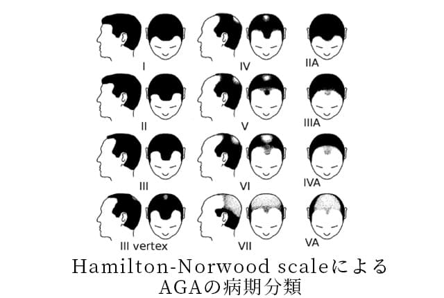 Hamilton-Norwood scaleによる AGAの病期分類