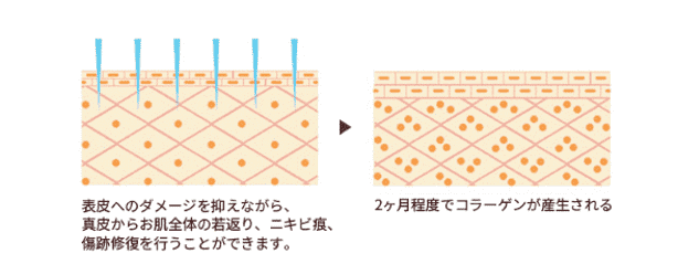 表皮へのダメージを抑えながら、真皮からお肌全体の若返り、ニキビ痕、傷跡修復を行うことができます。2ヶ月程度でコラーゲンが産生される。