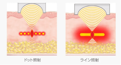 「ドット」と「リニア」の照射方式があります