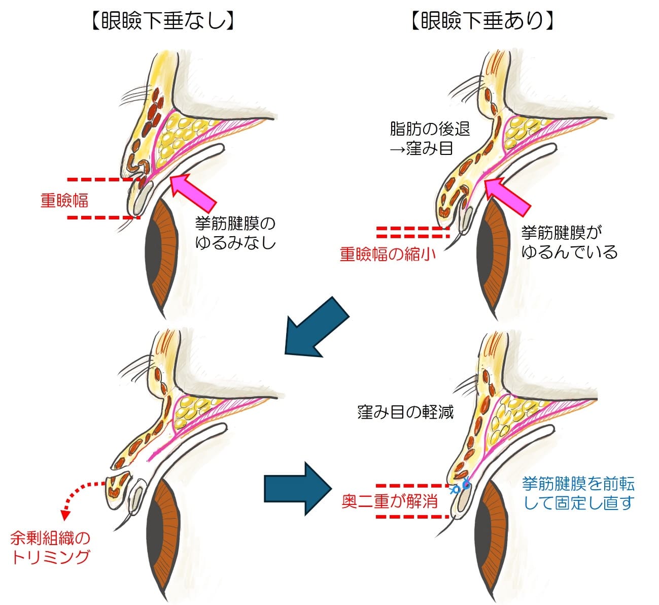 上眼瞼挙筋の処理