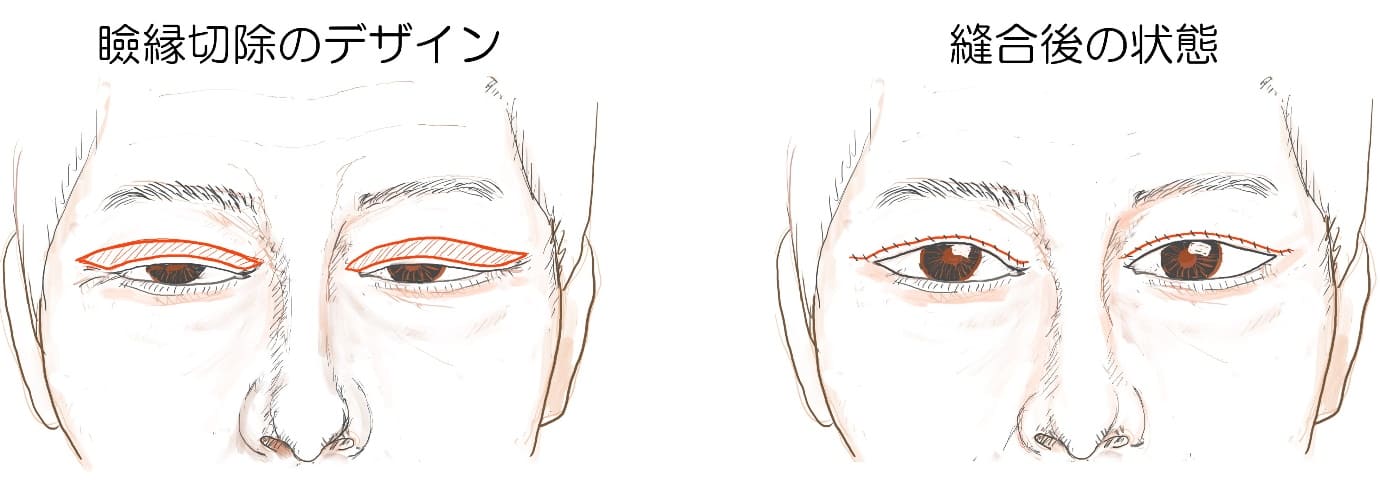 瞼縁切除による方法