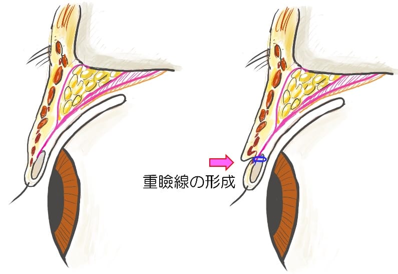 埋没法の種類