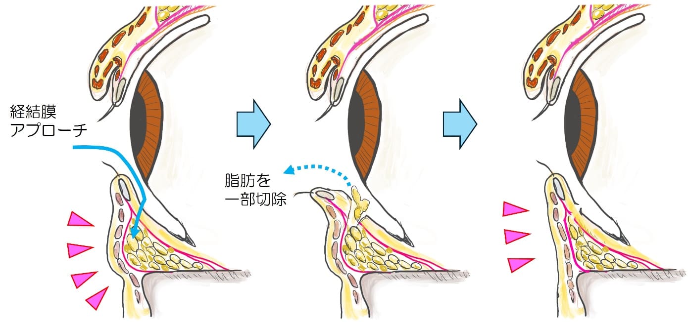 経結膜脱脂術（下まぶたのふくらみ(クマ)取り）