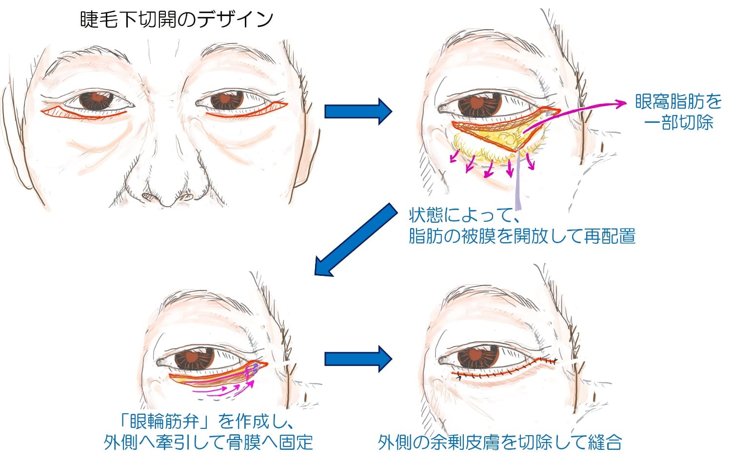 経皮的下眼瞼形成術（下まぶたのたるみ取り）