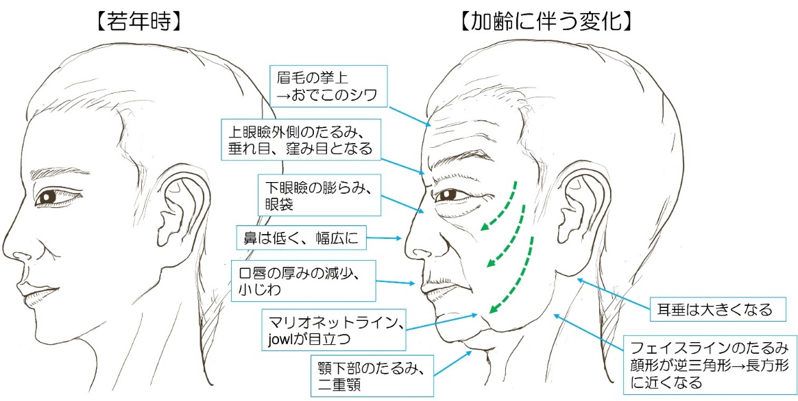 フェイスリフト手術