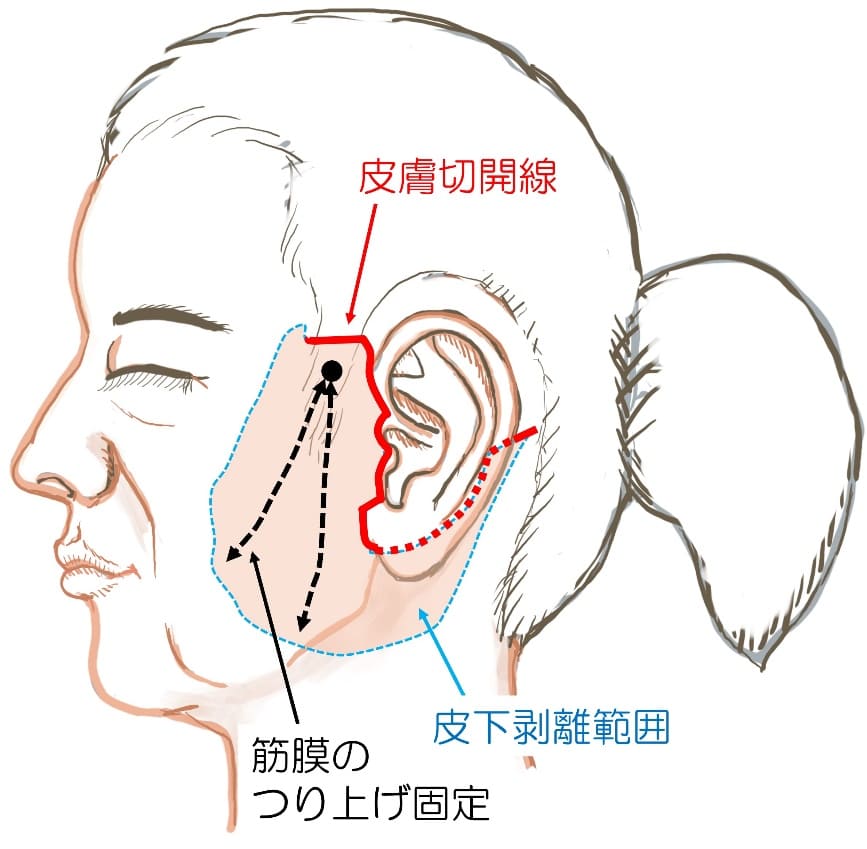 当院におけるフェイスリフト手術の特徴