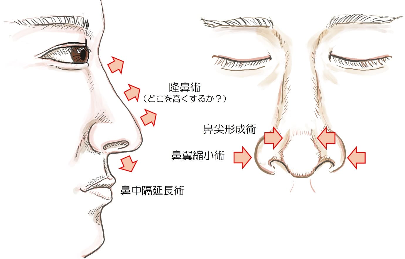 外鼻形成