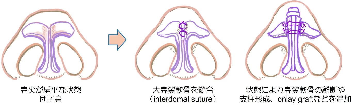 鼻尖形成術