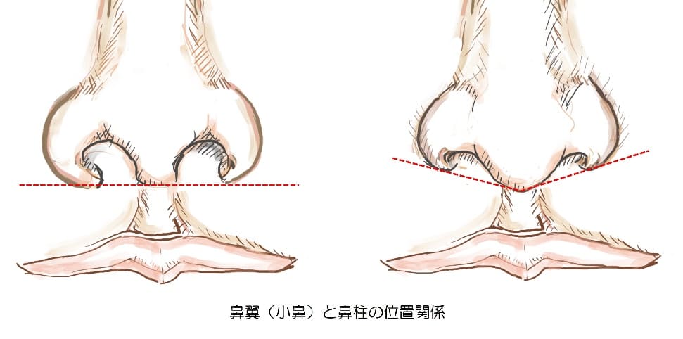 鼻中隔延長術