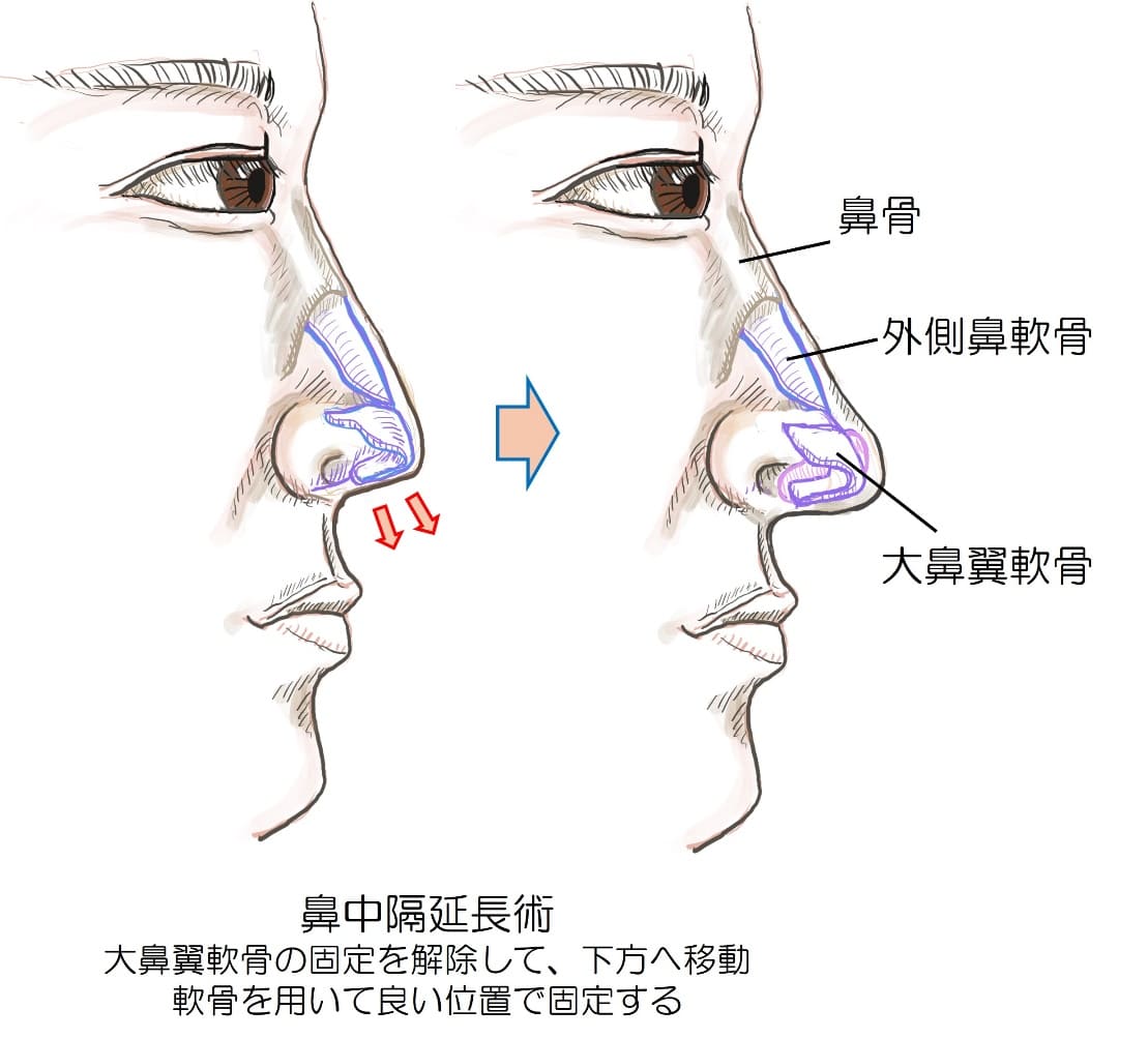 鼻中隔延長術