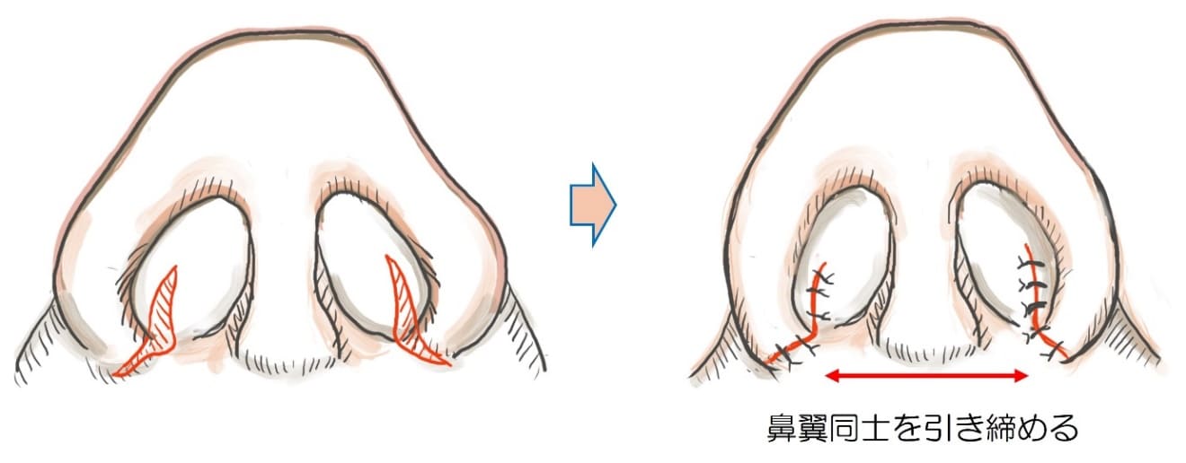 鼻翼縮小術