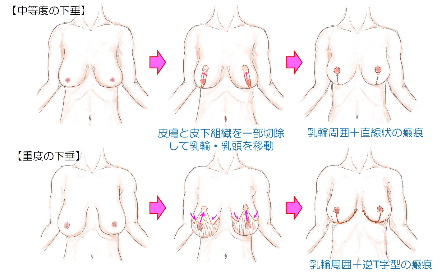 乳房下垂