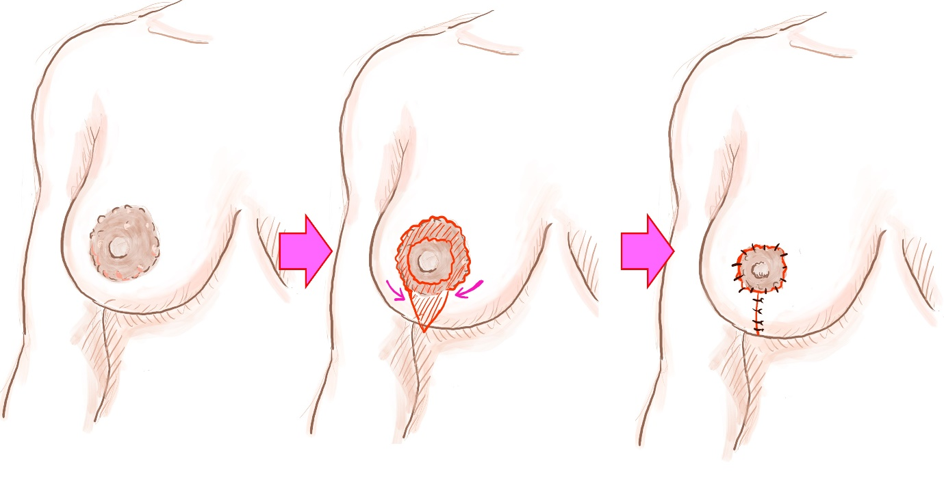 乳輪縮小術